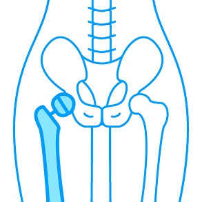 Endoprothesen