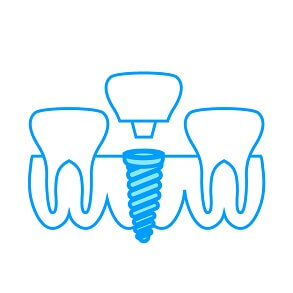 Offenes Implantat